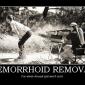 Hemorrhoid Removal